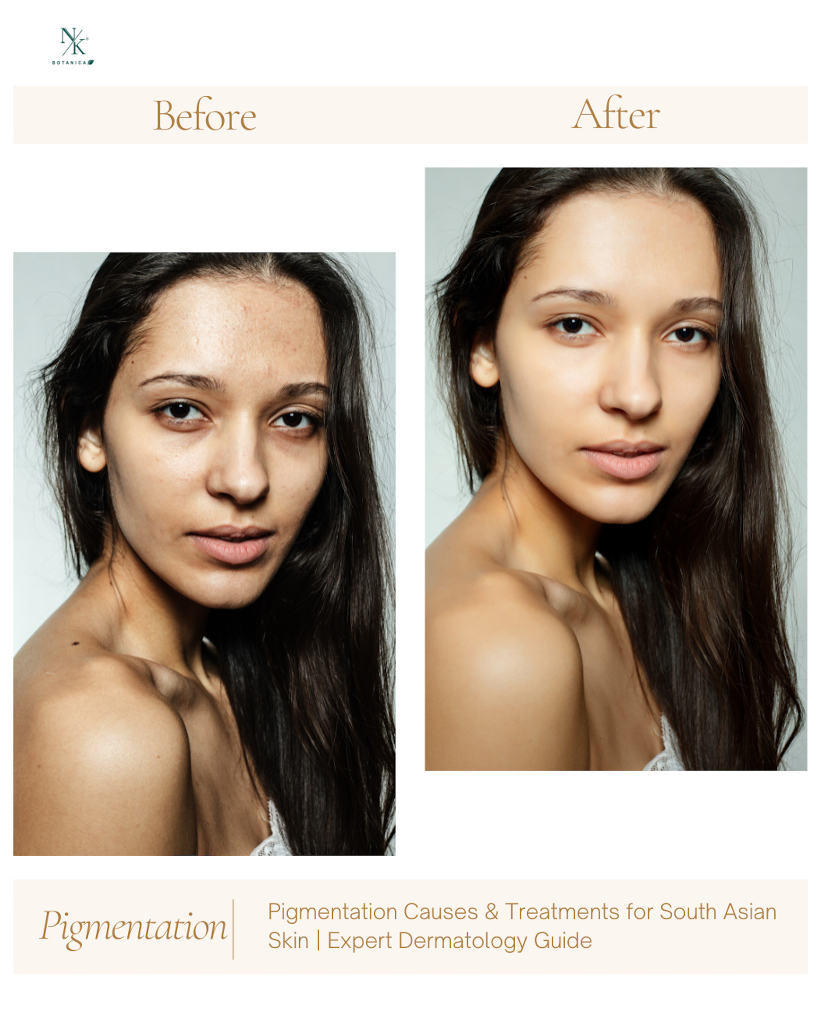 Discover what are Asian sun spots and Pigmentation causes