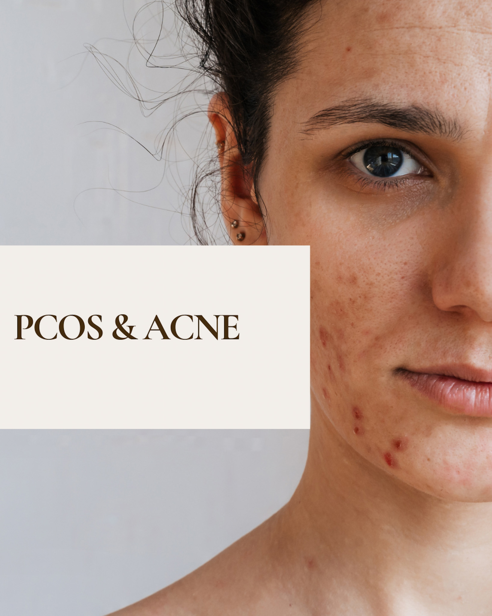 How to treat PCOS-Related Acne